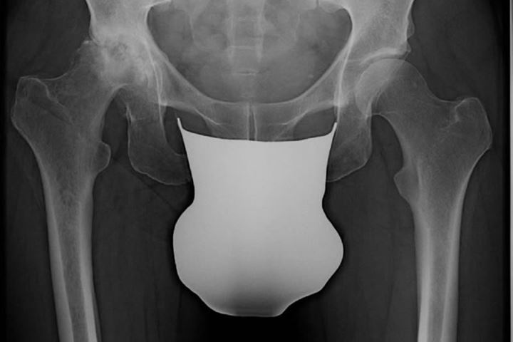 Röntgenbild einer schweren rechtsseitigen Hüftgelenksarthrose mit Hüftkopfeinbruch bei einem jüngeren 49-jährigen Mann.